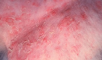Дерматит – это одно из самых распространенных кожных заболеваний